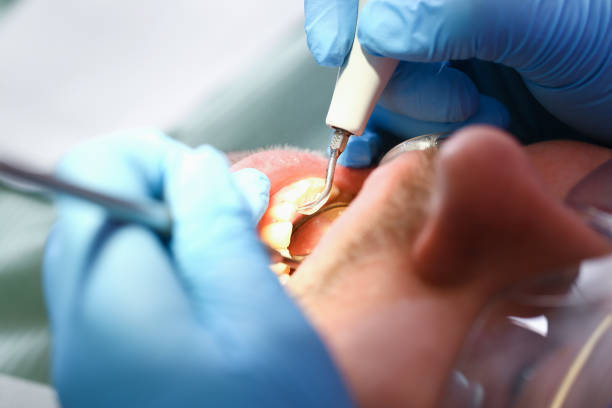 Best Emergency Tooth Extraction in Leonardtown, MD